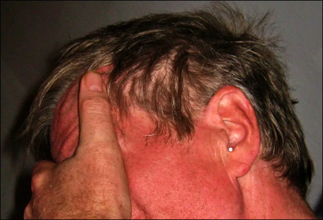 DRAINAGE IN THE EAR